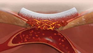 Αιμοστατικά